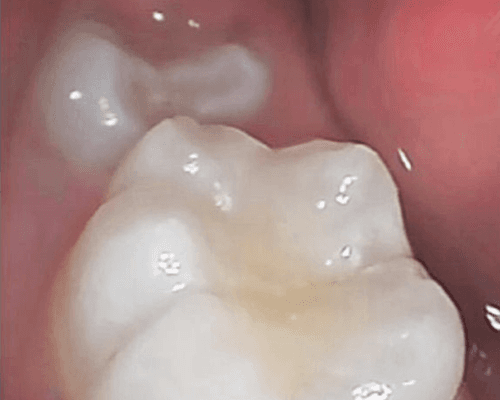 Tambal Gigi after treatment