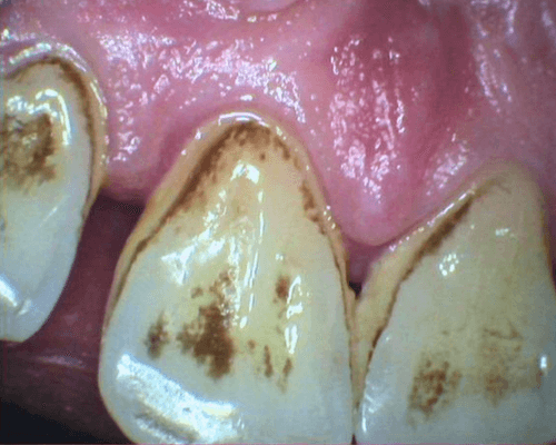 Scaling + Pembersihan Stain before treatment