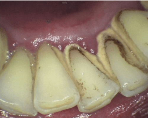 Scaling + Pembersihan Stain before treatment