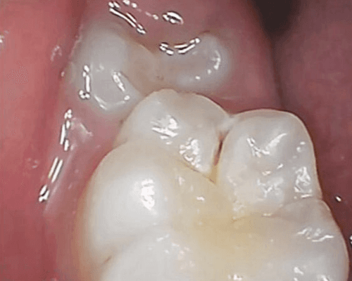 Tambal Gigi before treatment